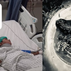 Timely Intervention Saves 8-Year-Old with Rare Bleeding Disorder After Critical Head Injury