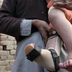 First Polio Case of 2026 Reported from Sujawal District, Sindh