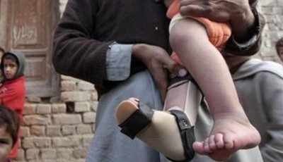 First Polio Case of 2026 Reported from Sujawal District, Sindh