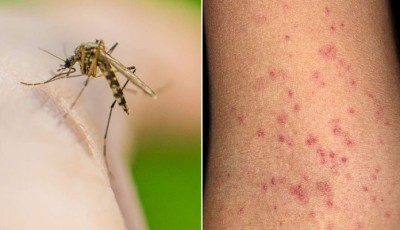 Dengue cases continue to rise across Sindh — over 1,100 new infections reported in 24 hours