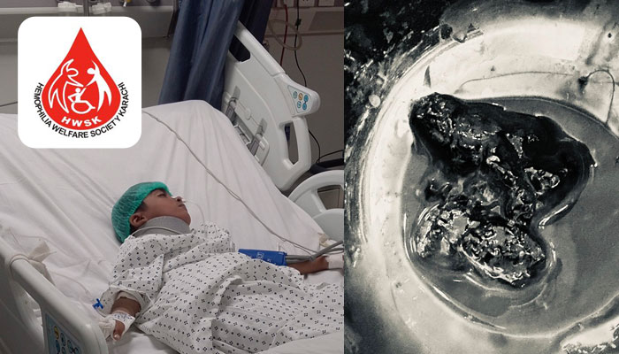 Timely Intervention Saves 8-Year-Old with Rare Bleeding Disorder After Critical Head Injury