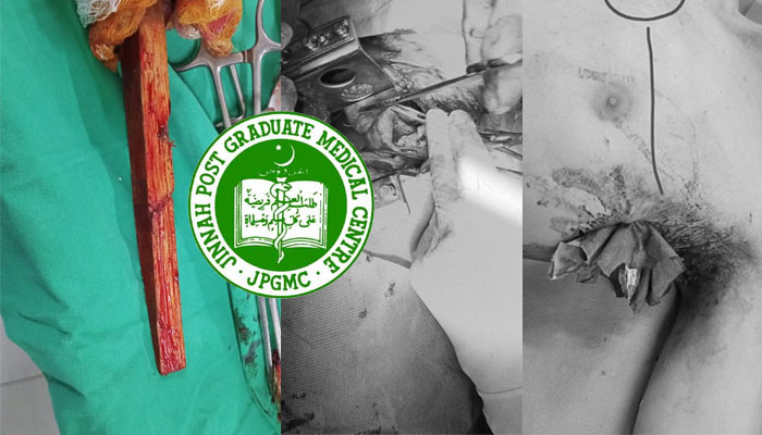JPMC doctors perform rare life-saving surgery after a wooden stick pierces a young man’s chest