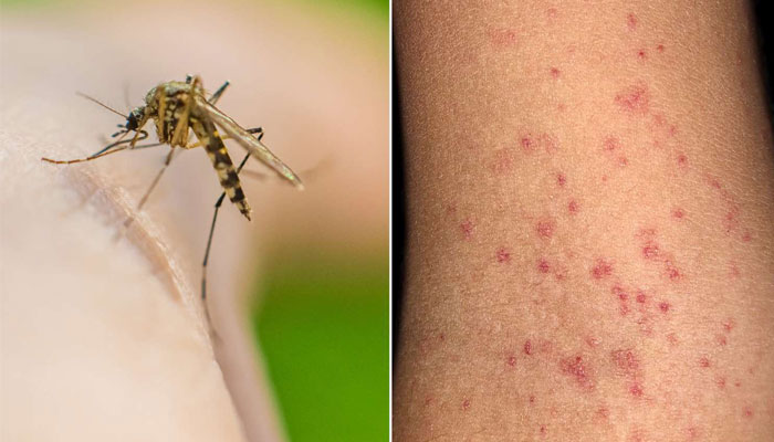 Dengue cases continue to rise across Sindh — over 1,100 new infections reported in 24 hours